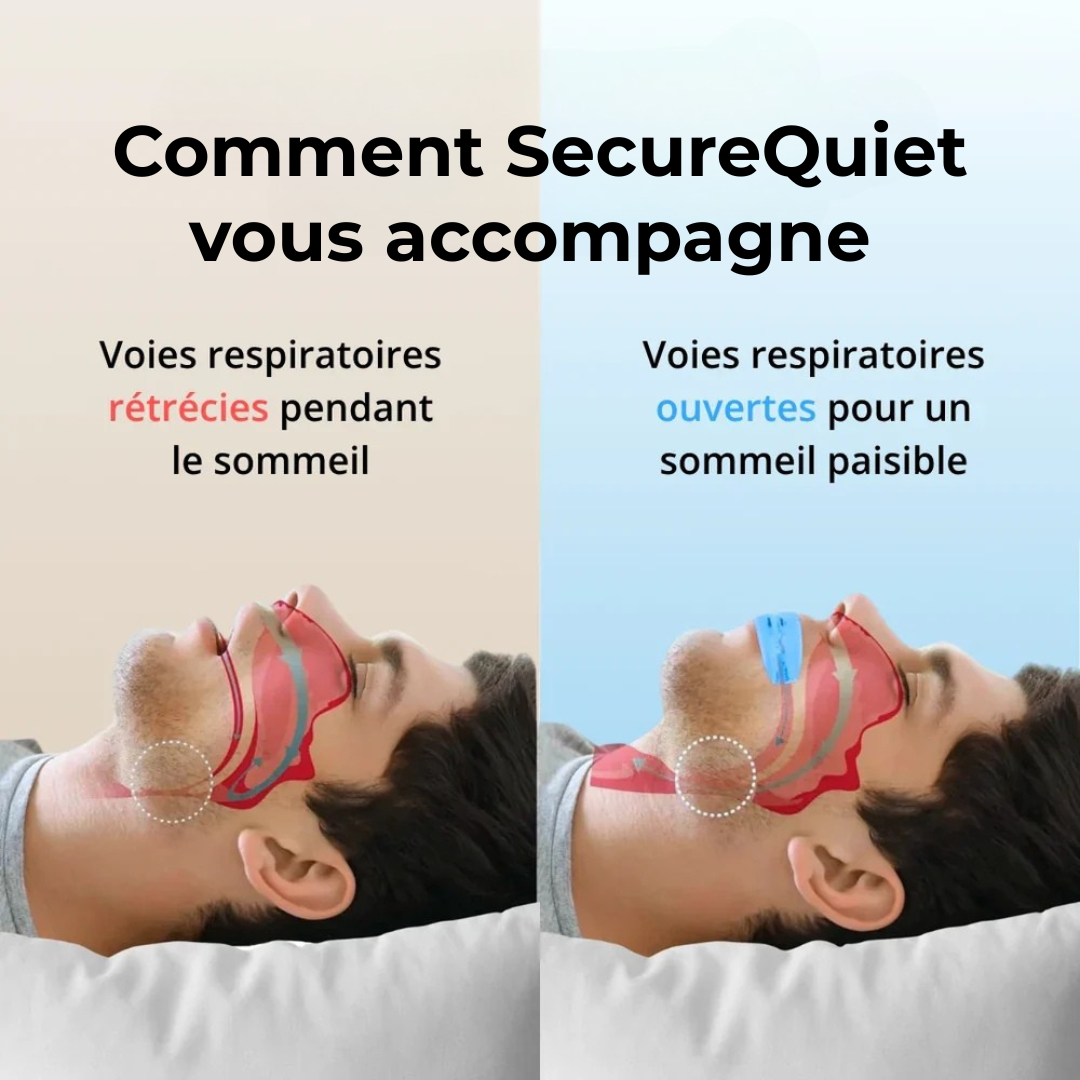 SecureQuiet | Appareil buccal anti-ronflement